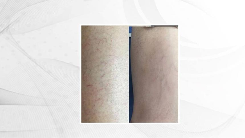 THREAD VEIN/SPIDER VEIN BEFORE AND AFTER